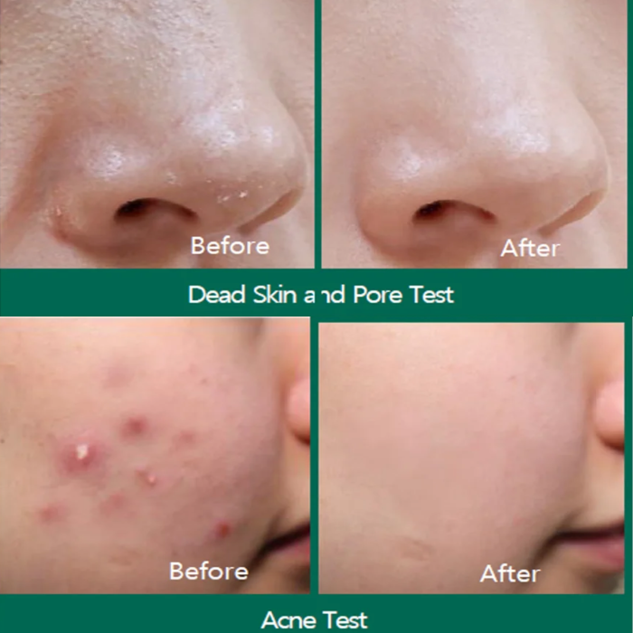 Some By Mi Miracle Cream | Before and After Some By Mi Miracle Cream | Before and After