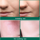 Some By Mi Miracle Serum | Before and After