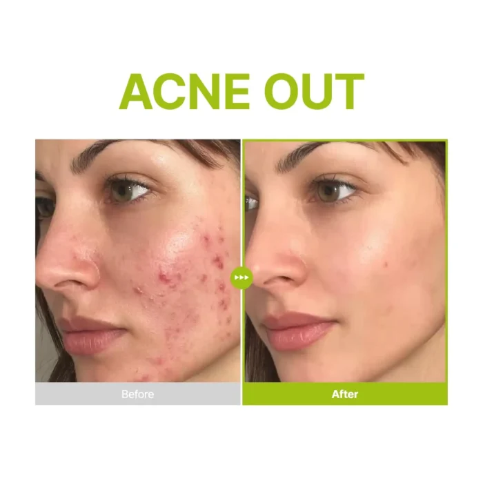 Purito - Azelaic Acid 10 Kojic Tea Tree Serum 2 Purito - Azelaic Acid 10 Kojic Tea Tree Serum 2