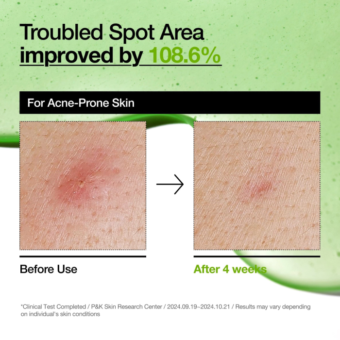 Anua - Azelaic Acid 10 Hyaluron Redness Soothing Serum 4 Anua - Azelaic Acid 10 Hyaluron Redness Soothing Serum 4