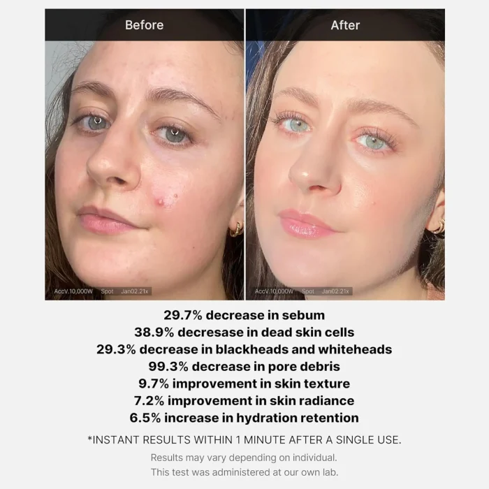 Medicube - Red Acne Succinic Acid Peel 3 Medicube - Red Acne Succinic Acid Peel 3